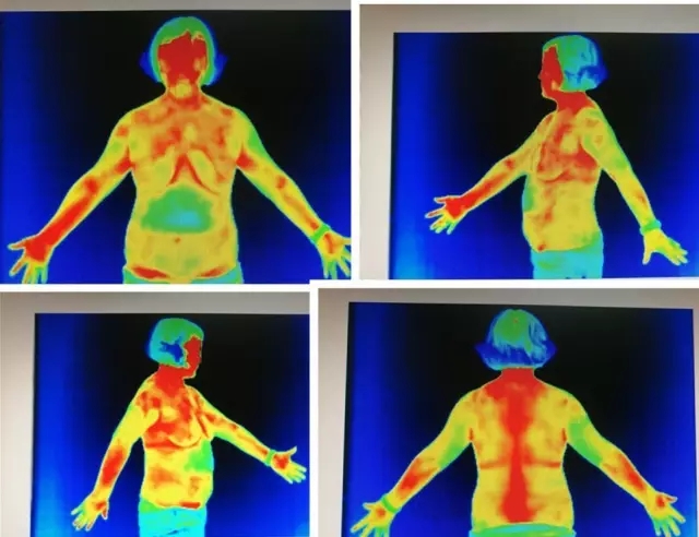 熱成像開辟了以功能學為主的全新醫學影像領域